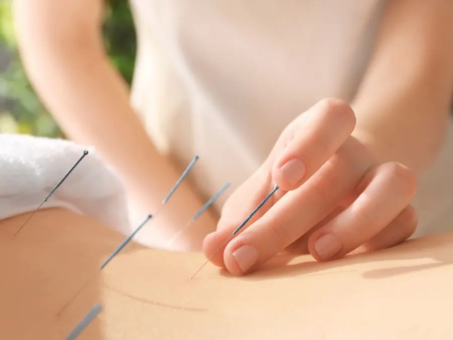 Person experiencing acupuncture